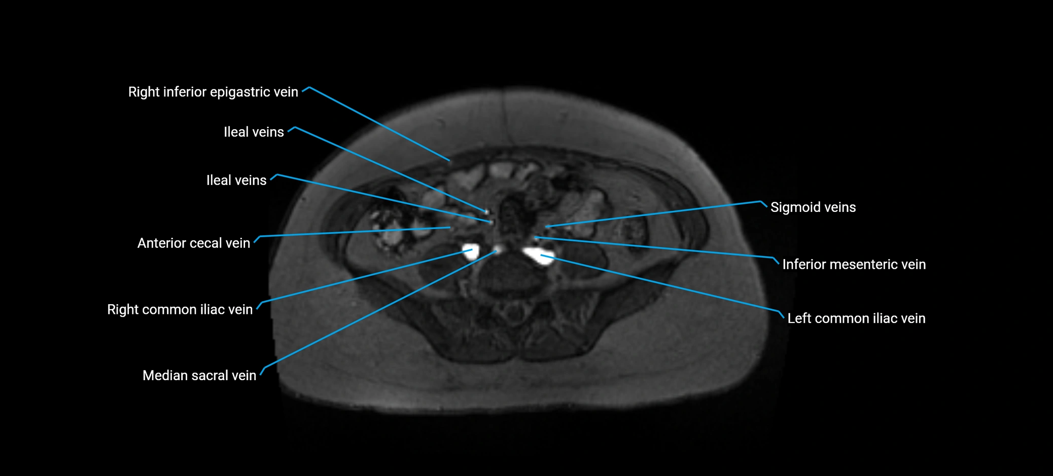 MRV abdomen pelvis & lower limb axial cross sectional anatomy labelled MRI image 126 (1).webp